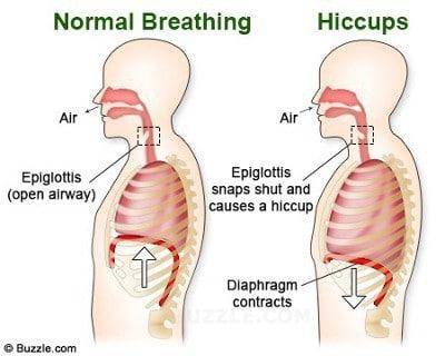 how to get rid of hiccups