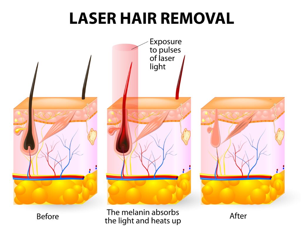 laser hair removal cost