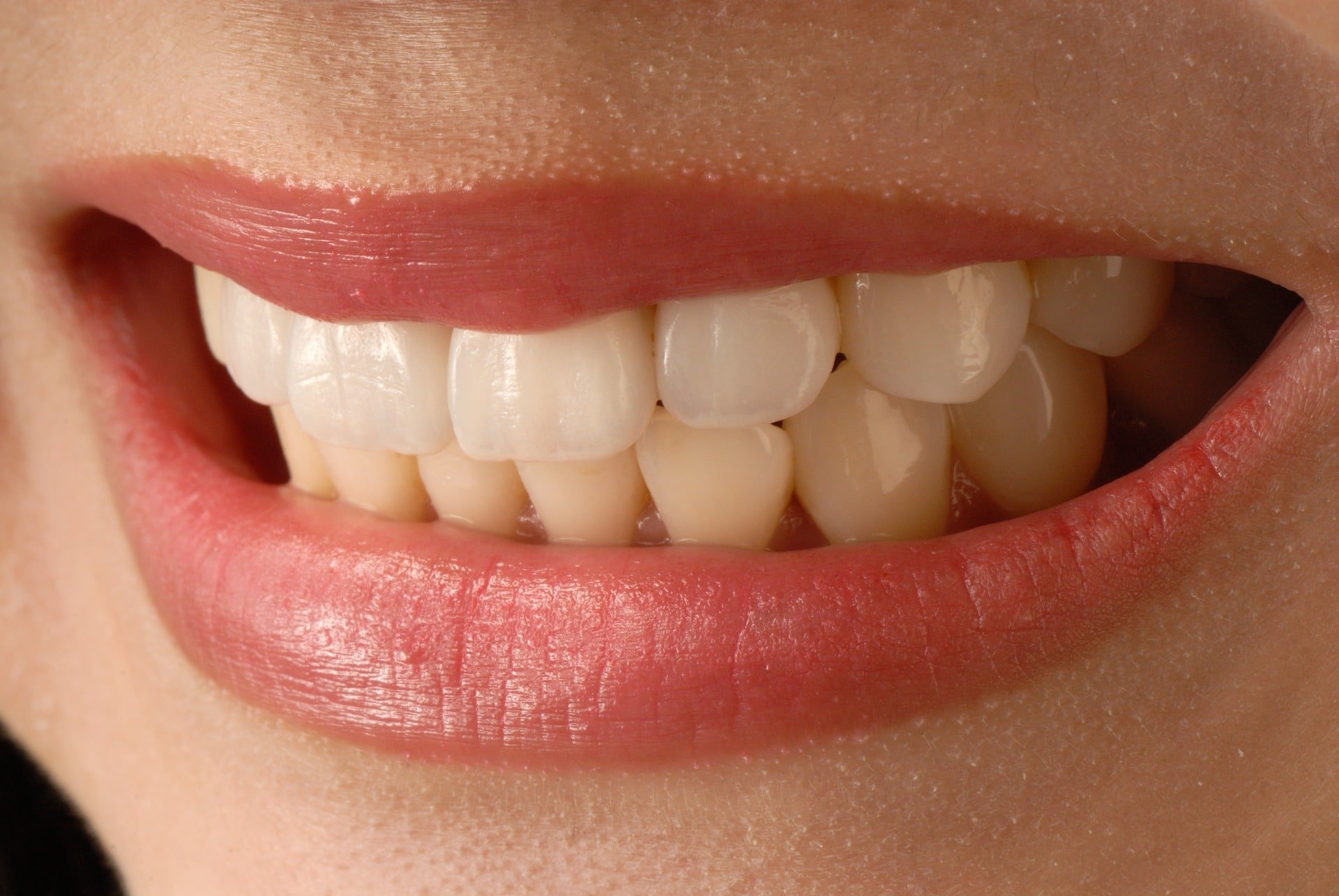 How Much Do Veneers Cost