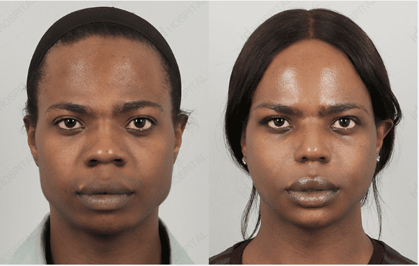 Facial Feminization Surgery